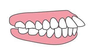 image:出っ歯（上顎前突）