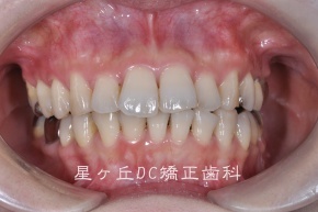 すれ違い咬合 院長ブログ 名古屋で歯列矯正なら星ヶ丘駅１分の星ヶ丘dc矯正歯科