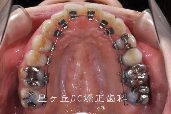 すれ違い咬合 院長ブログ 名古屋で歯列矯正なら星ヶ丘駅１分の星ヶ丘dc矯正歯科