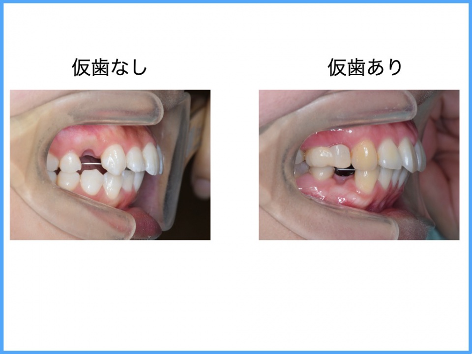 歯列矯正での抜歯のすき間 スタッフブログ 名古屋で歯列矯正なら星ヶ丘駅１分の星ヶ丘矯正歯科
