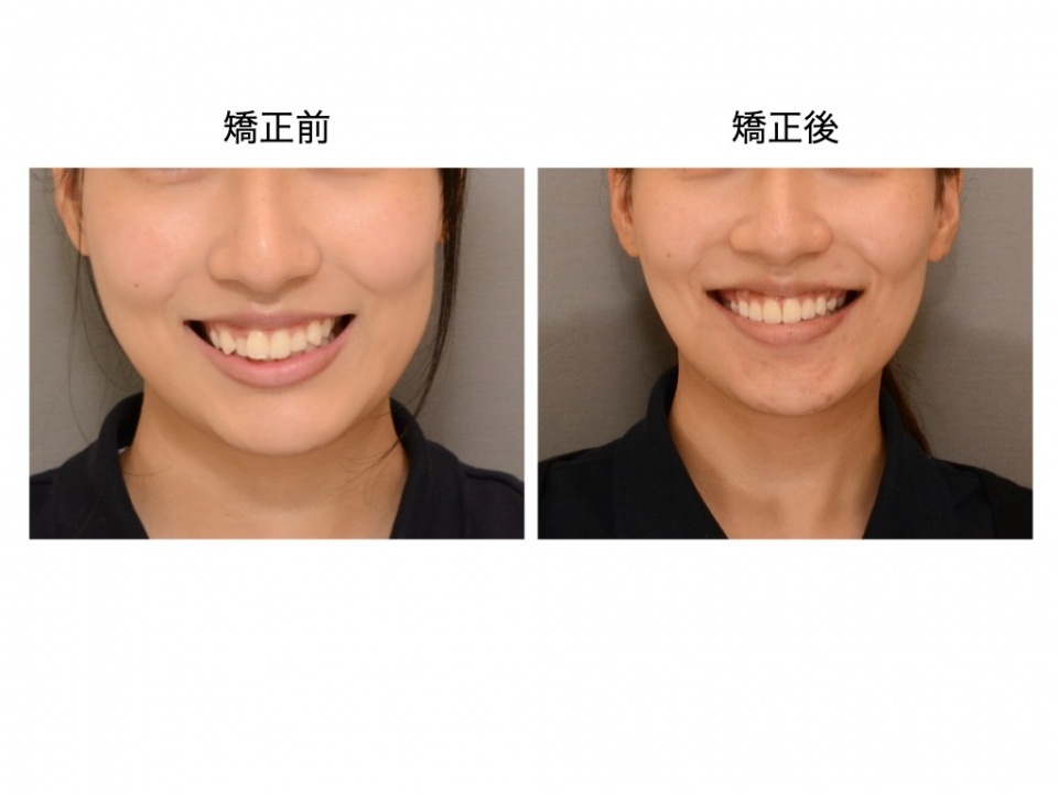 ミニブレースとは何ですか?