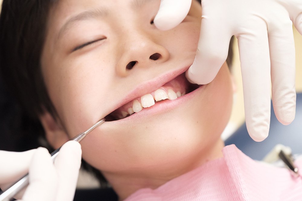 image:子供の歯列矯正で裏側矯正を選ぶメリット・デメリット