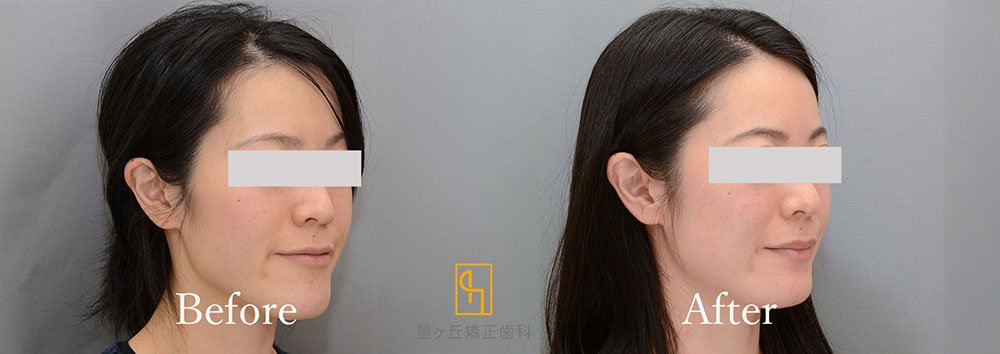 症例2:施術後のイメージ3