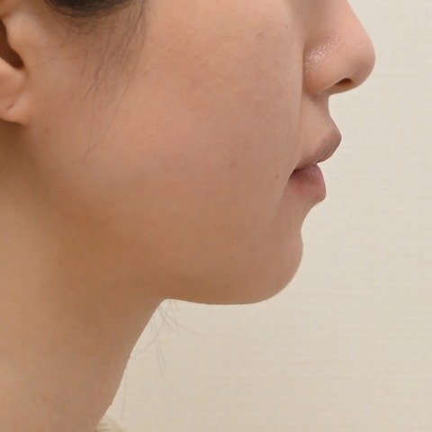 症例4 の治療後の横顔 (口元)