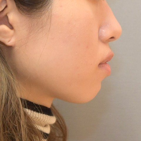 症例4 の治療前の横顔 (口元)