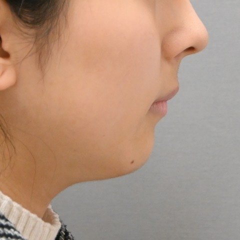症例1 の治療後の横顔 (口元)