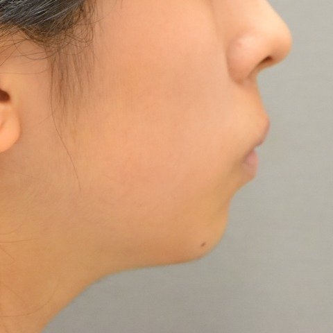 症例1 の治療前の横顔 (口元)
